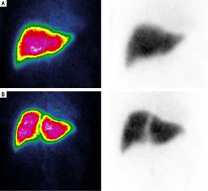 (A) Pre-stage1 and (B) post-stagel (POD5) scintigraphy in one patient scheduled for a right extended hepatectomy who underwent a laparoscopic partial ALPPS along the umbilical fissure up to the middle hepatic vein, showing a functional gain of the FRL (left lobe) of +44%.