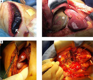 Laparotomy for stage2 of ALPPS along the umbilical fissure (A) with total parenchymal transection at the onset of ALPPS technique, showing bilious fluid within the perihepatic plastic bag (white arrow) and necrosis of the segment IV (white asterix) (B) by partial ALPPS performed laparoscopically, with no peritoneal fluid at laparotomy on POD6, no adhesion, and no necrosis of the segment IV (white asterix) despite interruption of its afferent pedicles.