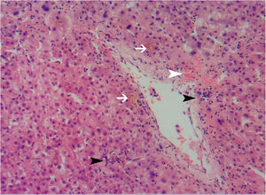 Microscopic features of the liver biopsy specimens (hematoxylin and eosin stain, ×100). Hemorrhaging around the terminal hepatic venule (white arrow), prominent intra-acinar lymphocytes and occasional neutrophils (black arrow), and canalicular and hepatocellular cholestasis (arrowhead) are visible.