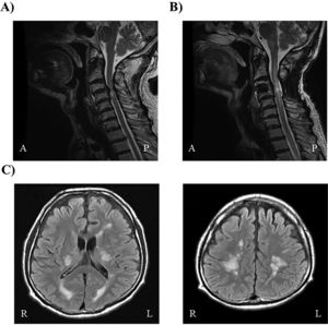 (A) Spinal magnetic resonance imaging performed before the first surgery for cervical spondylosis. An intramedullary limited lesion with high intensity is visible in the mid-portion of the cervical spinal cord (C3–4) on T2-weighted imaging. (B) Spinal magnetic resonance imaging performed after the second surgery for cervical spondylosis. An intramedullary lesion with high intensity is visible, extending into the mid-portion of the cervical spinal cord (C2-6) and brainstem on T2-weighted imaging. (C) Brain magnetic resonance imaging. Multiple high intensity lesions are visible within the internal capsule and deep white matter on both sides on T2-weighted imaging.