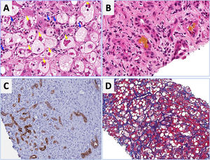 Characteristic histological findings in alcoholic hepatitis. Macrovesicular steatosis is the earliest and most common seen pattern. Hepatocellular injury is characterized by lobular infiltration of neutrophils (Panel A, blue arrows) with ballooned hepatocytes that often contain amorphous eosinophilic inclusions called Mallory-Denk bodies (Panel A, yellow arrows), bilirubinostasis (Panel B), ductular reaction (C) and liver fibrosis, which is typically described as pericellular and sinusoidal (“chicken wire” appearance) (Panel D).