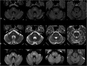 Axial (A) T2 FLAIR and (B) T2 weighted images demonstrate abnormal high signal in the central pons with sparing of the periphery. (C) Axial B1000 diffusion weighted images demonstrate correlating mildly increased signal without evidence of restricted diffusion on the ADC map (not shown) consistent with T2 shine through.