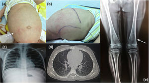 Clinical and radiological characteristics. Patient 1: (a) Note the maculopapular dermatitis (white arrow), umbilical hernia, enlarged abdominal circumference and (b) hepatosplenomegaly. Patient 2: (c) Chest X-ray and (d) CAT images showing lung infiltration; (e) X-ray of lower limbs shows the femur with Erlenmeyer flask-like image and growth arrest bands (white arrow).