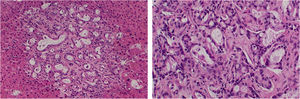 H&E stain showing desmoplasia and increased mucin production consistent with CC in left panel (10×) and right panel (20×).