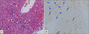 In Panel A, an H&E preparation (400×) shows large nuclear pseudo-inclusions and Mallory bodies in the periportal areas (red arrows), which are characteristic findings in WD. In Panel B, a Rhodanine preparation (400×) demonstrates increased copper deposition, depicted as gray granules (blue arrows).