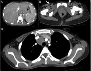 Axial section thorax and abdomen computed tomography, with contrast in the arterial phase. (A) Splenomegaly and enlarged lymph node in aortic chain (white arrow). (B) Bilateral iliac chain. (C) Large lymph node next to the right bronchus measuring 4cm.