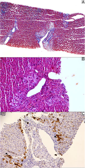 Liver biopsy. (A) Masson trichrome stain shows moderate portal fibrosis without septa. (B) The portal areas show a relatively mild lymphocytic infiltrate with prominent ductular reaction and cholestasis (pseudoxanthomatous change, arrow). (C) Cytokeratin 19 stain was used to identify the remaining ducts (arrow); they were positive in ductular reaction (arrowhead). The sample showed 10 portal tracts, of which 6 did not exhibit bile ducts, corroborating the diagnosis of loss of intrahepatic original ducts.