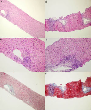 Microphotographs of liver histology. (A and B) First liver biopsy showing mild inflammation within portal tracts with lymphoid aggregate and mild interface activity consistent with HCV infection. No clear morphological evidence of autoimmunity. [Haematoxylin and Eosin stain. Magnification ×100 for A and ×200 for B]. (C) First liver biopsy stained for collagen showing a mild increase in portal fibrosis without evidence of fibrous septa or fibrous bridge formation. [Masson's Trichrome stain. Magnification ×100]. (D and E) Second liver biopsy showing moderate-severe portal inflammation with marked interface activity and moderate lobular inflammation with plasmacells. [Haematoxylin and Eosin stain. Magnification ×100 for D and ×200 for E]. (F) Second liver biopsy stained for collagen showing increased fibrosis with portal expansion and porto-portal fibrous septa at least. [Azan Mallory's Trichrome stain. Magnification ×100].