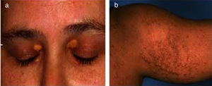 (a) Bilateral xanthelasmas of upper eyelids; (b) xanthomas involving the chest and arm.