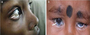 (a) Bitot's spot in right eye (arrow); (b) bilateral keratomalacia in a 7 month old child (arrow).