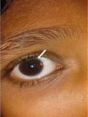 Kayser–Fleischer ring evident along the peripheral cornea superiorly (arrow).