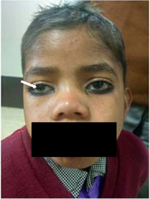 Corneal clouding in a boy with mucopolysaccharidoses type 1 (arrow).