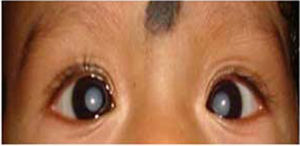 Bilateral cataract in an infant.