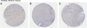 Basal expression level of CD98 in normal hepatic tissue. CD98 expression assessed by immunohistochemistry staining from tissue samples (brown). (A) Female age 18, (B) Male age 40, (C) Male age 47.