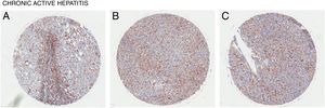 CD98 upregulation in liver tissue with chronic active hepatitis. CD98 expression assessed by immunohistochemistry staining from tissue samples (brown). (A) Female age 58, (B) Male age 49, (C) Male age 36.