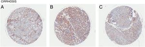 CD98 upregulation in liver tissue with cirrhosis. CD98 expression assessed by immunohistochemistry staining from tissue samples (brown). (A) Female age 60, (B) Female age 26, (C) Male age 57.