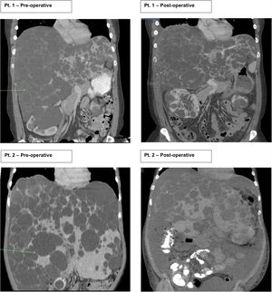 Coronal CT images representing pre-operative and post-operative scans for Pt. 1 and Pt. 2 respectively. Pre-operative images, the arrow represents the right lobe cystic tissue.