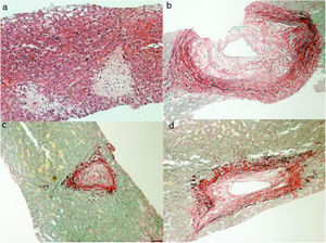 (a) Lobular center veinsclerosis. HE 200×. (b–d) Lobular center veinsclerosis. Picrossírius 200×.
