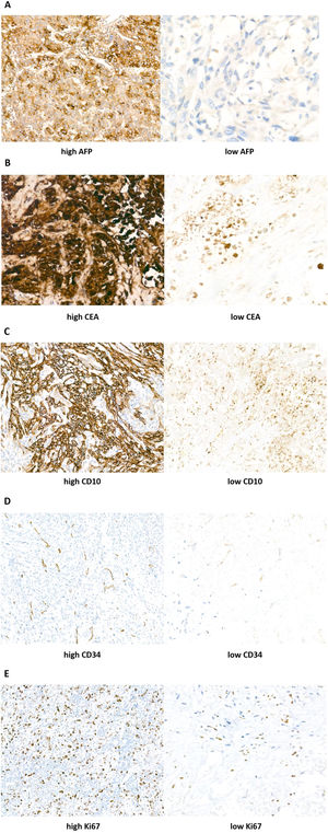 Immunohistochemistry (IHC) staining results of AFP, CEA, CD10, CD34, and Ki67 in ICC tumor tissues (Streptavidin–peroxidase conjugated method, 400× magnification). According to the intensity scores: (A) AFP expression was divided into high left. and low right. (B) CEA expression was divided into high left. and low right. (C) CD10 expression was divided into high left. and low right. (D) CD34 expression was divided into high left. and low right. (E) Ki67 expression was divided into high left. and low right.
