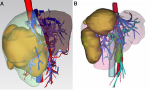 3D reconstruction of the liver tumors. A shows HCC (yellow color) in the right liver lobes. B shows two liver metastases secondary to colon cancer(yellow color) in the right liver lobes.