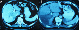 Pre-operative CT images of a patient with HCC. A shows a huge carcinoma of 10 cm × 8.5 cm × 8.0 cm in right liver lobes before the 1-stage operation. B shows the hyperplasia of left liver lobes before the 2-stage operation.