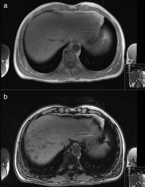 MR Images in 52-year-old man with liver cirrhosis and multiple nodules. Axial T1-weighted GRE in-phase (a) image does not depict any lesion but the out-of-phase image (b) shows multiple nodules in the right lobe of liver with homogeneous signal loss, indicating intra-lesional fat.