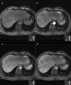MR Images performed before (a) and after intravenous injection of gadoxetic acid of a histology proven hepatocarcinoma (HCC). Axial arterial phase T1-weighted MR image (b) shows multiple nodular areas of early enhancement involving the right lobe. Axial portal venous (c) and delayed (d) phase T1-weighted MR images show washout appearance of the nodules.