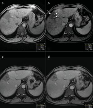 MR Images performed 9 years after treatment before (a) and after intravenous injection of gadoxetic acid. The nodular lesions are no longer seen in any of the sequences. There is a subcapsular hipointense area in dynamic T1-weighted MR images, causing capsular retraction (arrow in b) suggestive of a fibrotic area. There are small vessels (dashed arrows) but no suspicious nodular enhancing areas are seen.
