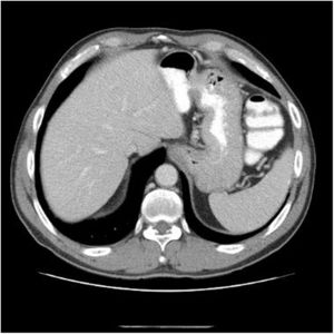 CT scan (portal venous phase): Scan just before antiviral treatment, without abnormal findings.
