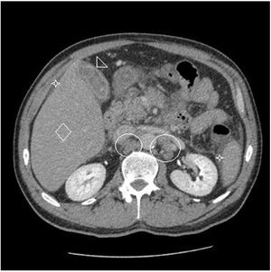 CECT scan. Inhomogeneous liver appearance (diamond shape), enlarged para-aortic lymph nodes (oval shapes), gallbladder stones (arrow head) and perihepatic and perispleenic ascetic fluid collections (asterisks).