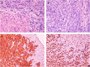 Liver biopsy depicting extensive infiltration from aggressive large B-cell lymphoma. A & B: H & E stain, C: CD20 cytoplasmatic positive expression, D: PAX-5 nuclear positive expression.