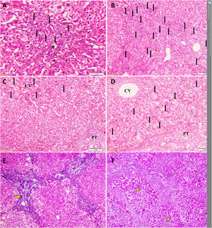 Temporal histopathological changes in biliary atresia. A: Mild bile ductular proliferation (BDP) (arrows) and C: giant cells (arrows) around the CV in the first liver biopsy of a 61-day-old infant. B: Moderate BDP and D: giant cells with diffuse distribution (arrows) in the second liver biopsy of the same infant at an age of 79 days. E: Grade-2 fibrosis (arrow) in the first liver biopsy of another 71-day-old infant that progressed to (F) grade-4 fibrosis (stars) in his second liver biopsy at an age of 82 days Slides: A to D (Hematoxylin and eosin, ×200), E and F (Masson’s trichrome stain, ×40) CV: central vein, PT: portal tract.