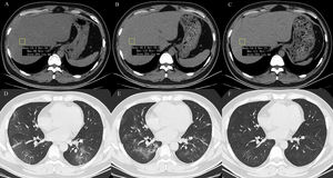 A 39-year-old man with COVID-19 pneumonia. Changes in liver attenuation on serial chest CT examinations. (A) a section of the liver shows hypoattenuation (mean attenuation: 34.4 HU) in the liver parenchyma on initial chest CT scan (obtained on day 4 after the onset of symptoms); (B) a section of the liver shows an increase in liver attenuation (mean attenuation: 48.8 HU) on the second chest CT (day 10 after the onset of symptoms); (C) a section of the liver shows continued recovery in liver attenuation (mean attenuation: 54.0 HU) on the third chest CT scan (day 15 after the onset of symptoms); (D) initial chest CT scan shows multifocal patchy ground-glass opacities (GGO) in two lungs; (E) the second chest CT image shows dissipation of GGO in the left lower lobe and a mild enlargement of GGO in the right lower lobe; (F) the third chest CT image shows demonstrative absorption.