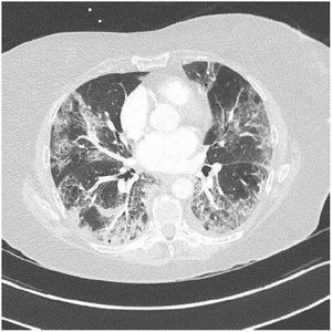 Lung parenchyma lesions in COVID-19: Patient with COVID-19 infection who presented lung parenchyma lesions on chest CT without iodine contrast, stage (extended lesions 50-75 % of lung parenchyma: bilateral peripheral ground-glass opacities: classification of the French Society of Thoracic Imaging.