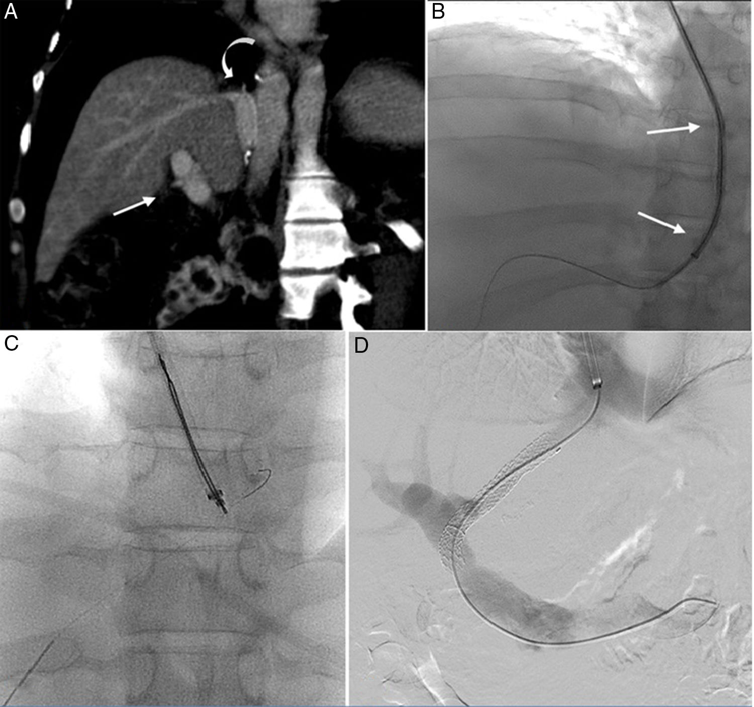 Tips Ct Tips for TIPS: A combined percutaneous and transjugular approach for ...