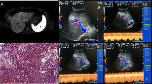 (A) Post-contrastographic sequences of liver MRI showing multiple hypodense focal lesions, more evident at the dome and the right lobe which show shrinking of the signal in DWI sequences; concomitant minimal dilatation of the intrahepatic bile ducts. (B) Section of hepatic specimen (1921×991; 20×) with evidence of hematologic extravasation, hepatocyte necrosis, focal dilation and congestion of sinusoids. (C) 6-Months after TIPS placement Doppler examination showing the patency of intrahepatic stent with high caval and portal velocity; no evidence of abdominal ascites.