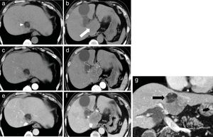 Findings of dynamic computed tomography. (a, b) Plain phase showed a 60-mm round tumor in segment 1. The majority of the tumor exhibited slightly low density (white arrow). It contained a very low density lesion, indicating fat deposits, only at the cranial aspect of the tumor (white arrow head). (c, d) The arterial phase showed a round tumor with iso-enhancement. (e, f) The late phase showed hypo-enhancement. The fat deposits at the cranial aspect were avascular in all phases. (g) Coronal view of the late phase showed that the low attenuation round tumor included very low density foci only on the right side of the cranial aspect of the tumor.
