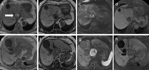 Findings of gadolinium-ethoxybenzyl-diethylenetriamine enhanced magnetic resonance imaging. (a) In-phase T1-weighted image of cranial aspect of the tumor showed a hyperintense lesion. (b) Out-phase T1-weighted image of the same slice showed a signal decrease in the lesion. (c) Diffusion-weighted image of the same slice showed iso-intensity. (e) In-phase T1-weighted image of caudal area of the tumor showed a hypointense lesion. (f) Out-phase T1-weighted image of the same slice showed no signal decrease. (g) Diffusion-weighted image of the same slice showed marked hyper-intensity. (d, h) The tumor showed low intensity in the hepatobiliary phase.