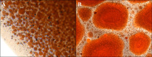 Light microscopic findings of the water-in-oil emulsion showing small droplets after 20 pumping exchanges at time 1 (A) and larger droplets 5min after preparation (time 2) (B).