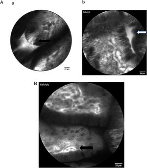 (A): intestinal villi with intraepithelial gap (black arrow) and increased luminal fluorescence (white arrow) as a sign of increased permeability. (B): intestinal villi without gaps, intravascular fluorescence (black arrow), no increased intraluminal fluorescence.
