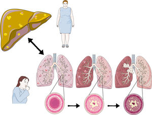 The inflammatory component caused by NAFLD can perpetuate oxidative stress and inflammation of the bronchus. In turn, patients’ difficulty to perform physical activity can aggravate the fatty liver process. Hypercholesterolemia and NAFLD may contribute to an increased risk of pulmonary adenocarcinoma.