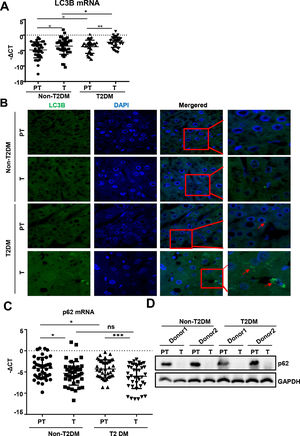 Autophagy is upregulated in HCC tissues than in para-tumor tissues. (A)The real-time qPCR analysis of transcripts of LC3B in HCC and para-tumor tissues in patients with T2DM or not. (B) The immunofluorescence analysis LC3 in HCC and para-tumor tissues in patients with T2DM or not. (C) The real-time qPCR analysis of transcripts of p62 in HCC and para-tumor tissues in patients with type 2 DM or not. (D) The western blotting analysis of p62in HCC and para-tumor tissues in patients with DM or not. The expression was normalized to GAPDH. Error bars represent means ± SD. The p62 transcripts expression was normalized to ACTB and presented as -ΔCt. * P<0.05, * P<0.51, *** P<0，*** P<0.001.001.