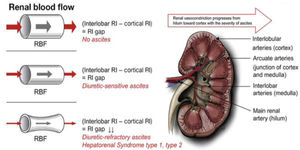 Role of renal vasoconstriction in acute kidney injury (RBF: renal blood flow; RI: renal resistive index).