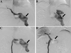 Fluoroscopy and digital subtraction images (A, before embolization, splenic venography shows the hepatofugal flow in the splenic vein and a large splenorenal shunt, black arrow shows the large shunt; B, before embolization, shunt venography shows the blood flow in shunt enters systemic circulation, black arrow shows the large shunt; C, before embolization, superior mesenteric venography shows hepatofugal flow in the splenorenal shunt, black arrow shows the large shunt; D, after embolization, superior mesenteric venography shows increased hepatopetal flow in the portal vein and no flow in splenic vein, black arrow shows the embolic site).