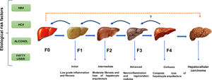 The natural course of liver disease is triggered by HBV, HCV, alcohol, or fatty liver. () HCC is a long-term, multi-step process involving initial, intermediate, advanced  fibrosis, and cirrhosis. Fibrosis may be reversible if the insulting agent is withdrawn. () HCC is known to present without cirrhosis.