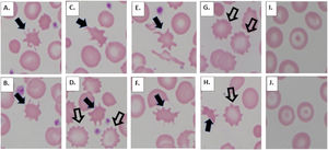 Abnormal red blood cell morphologies associated with advanced liver disease. Acanthocytes (A-F, H, solid arrows) are red blood cells with no central pallor displaying relatively long projections which show uneven distribution across the cell surface. Echinocytes (D, G, H, open arrows) are red blood cells with central pallor and short projections which are evenly distributed on the cell surface, forming a "ruffled border." Codocytes (I, J) are red blood cells with a "bullseye," target-like appearance.