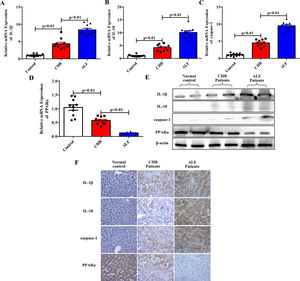 The related gene and protein expression levels in individuals with ALF. (A-E) The expression levels of IL-1β, IL-18, caspase-1 and PPARα were analyzed by qRT-PCR (n=10) and western blotting methods for the three groups. Representative western blots of two samples from each group were displayed. (F) Staining of IL-1β, IL-18, caspase-1 and PPARα in the three groups by immunohistochemistry.