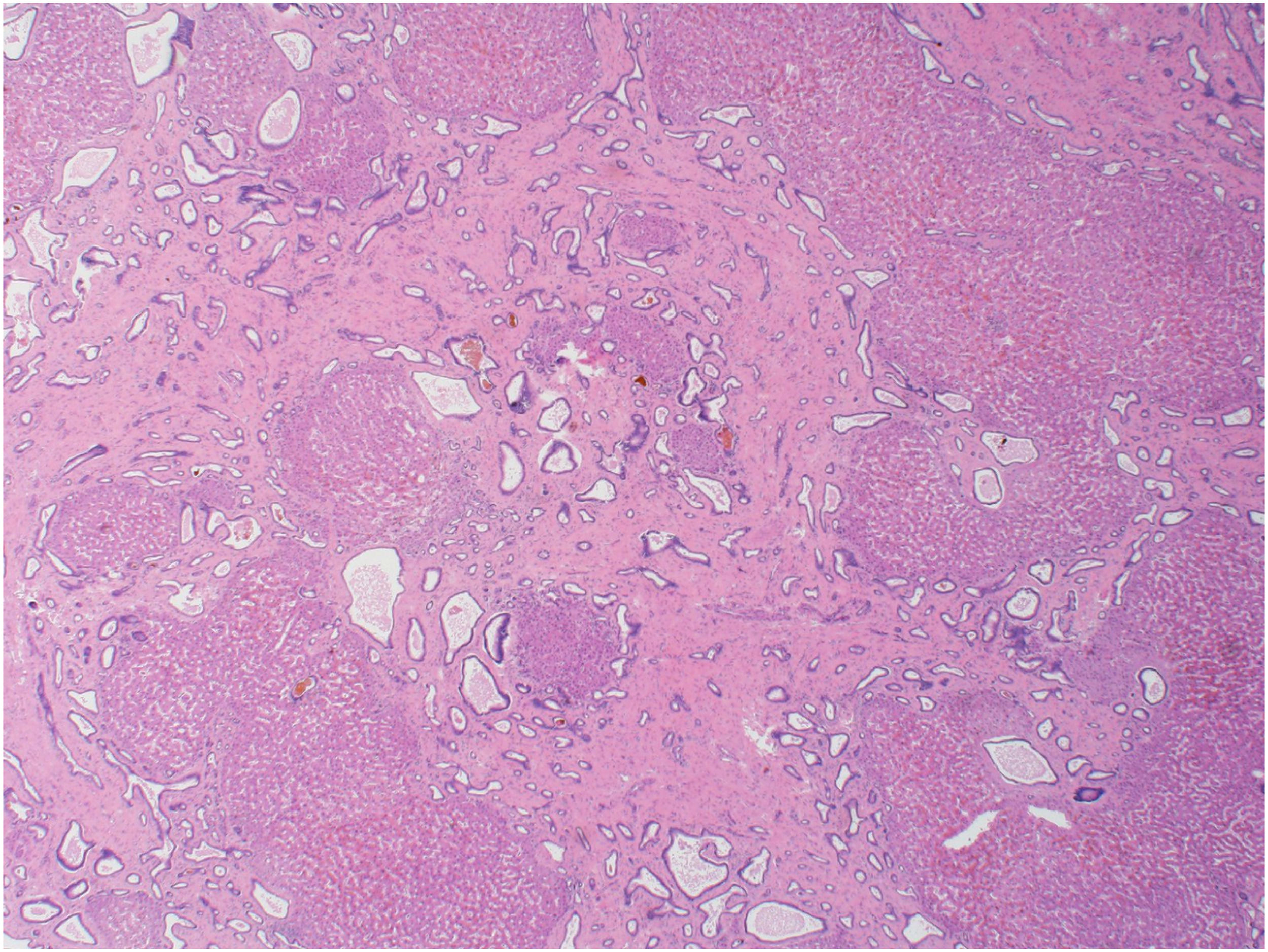 A clinical review of congenital hepatic fibrosis diagnosed in adulthood ...