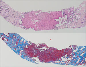 Liver biopsy (H&E and trichrome stain) demonstrating characteristic features of CHF. Unevenly distributed bile ducts with irregular profiles. In the middle is an island of hepatic parenchyma.