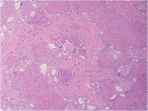 Low power image of a liver with CHF. This image demonstrates geographic areas of fibrosis with evenly spaced bile ducts, some of which are dilated and contain bile plugs.